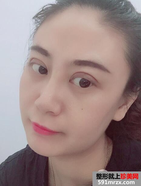 切开双眼皮价格5860元恢复一周效果图案例