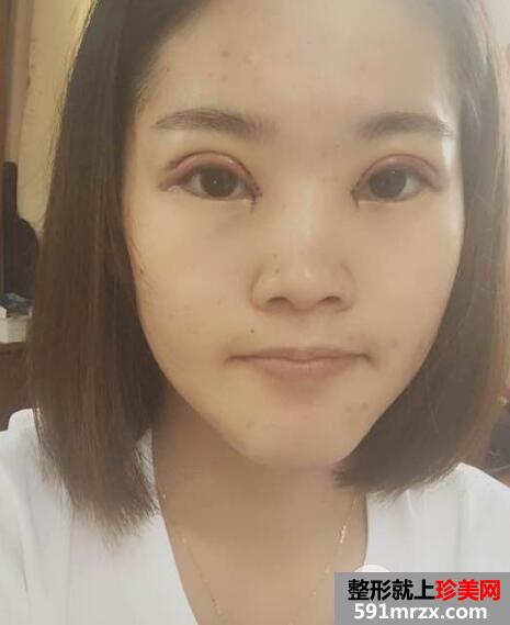 上海华美医院整形价格表和割双眼皮恢复案例