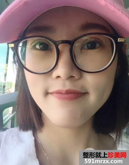 上海华美医院整形价格表和割双眼皮恢复案例