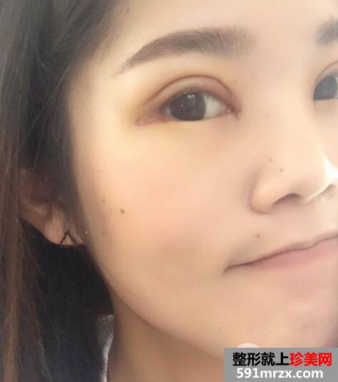 上海华美医院整形价格表和割双眼皮恢复案例
