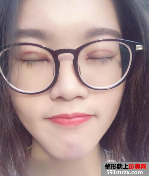 上海华美医院整形价格表和割双眼皮恢复案例