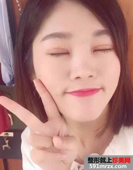 上海华美医院整形价格表和割双眼皮恢复案例