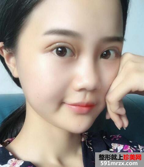 长沙爱思特切开双眼皮1-5天恢复图片