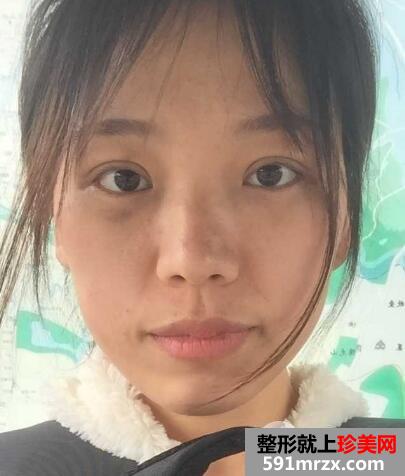 全切双眼皮恢复一个月就变漂亮美丽了