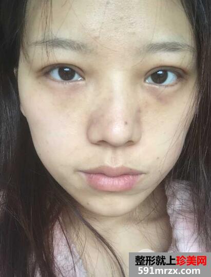 全切双眼皮恢复一个月就变漂亮美丽了