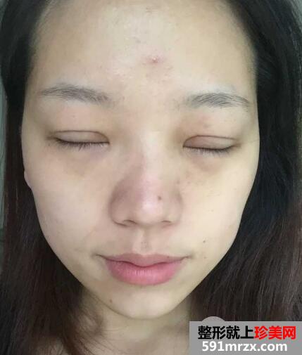全切双眼皮恢复一个月就变漂亮美丽了