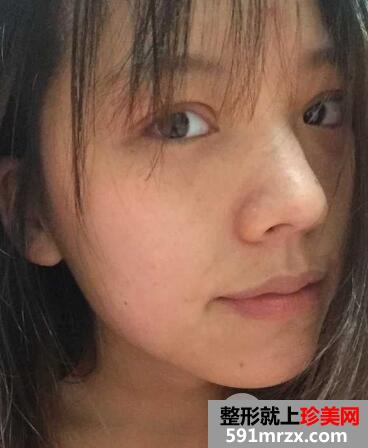 全切双眼皮恢复一个月就变漂亮美丽了