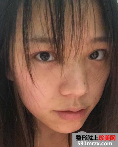 全切双眼皮恢复一个月就变漂亮美丽了