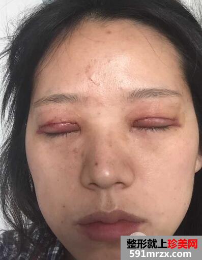 全切双眼皮恢复一个月就变漂亮美丽了