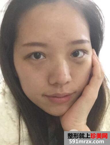 全切双眼皮恢复一个月就变漂亮美丽了