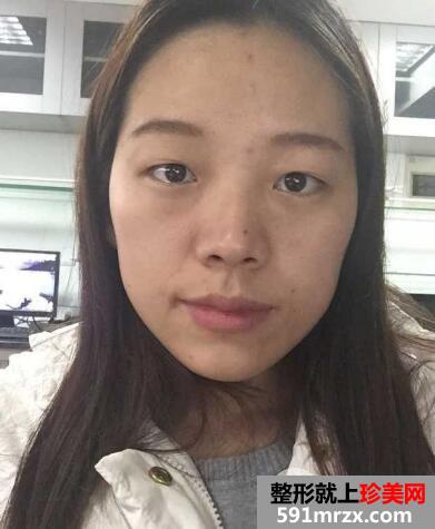 全切双眼皮恢复一个月就变漂亮美丽了