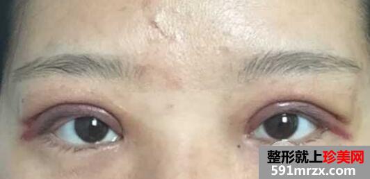 全切双眼皮恢复一个月就变漂亮美丽了