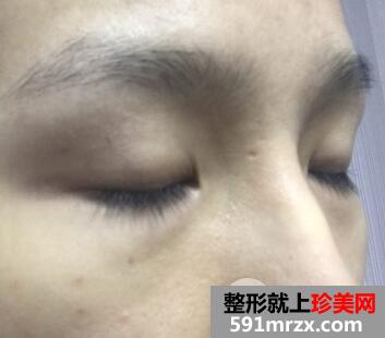 秦皇岛纪辉医院整形价格表|附全切双眼皮案例