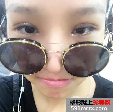 秦皇岛纪辉医院整形价格表|附全切双眼皮案例