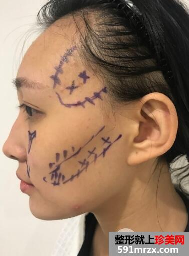 北京东方和谐整形自体脂肪面部填充由丑变美案例