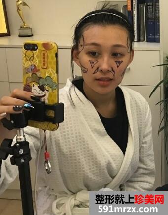 北京东方和谐整形自体脂肪面部填充由丑变美案例