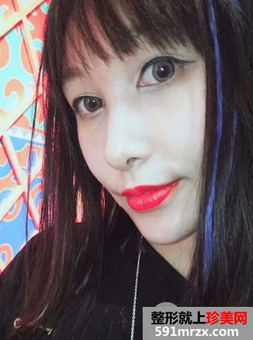 北京东方和谐整形自体脂肪面部填充由丑变美案例