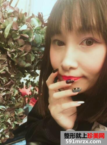 北京东方和谐整形自体脂肪面部填充由丑变美案例