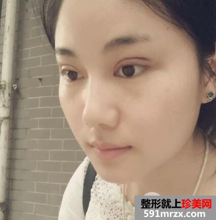 四川娇点整形价格表 切开双眼皮整形案例分享