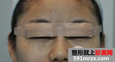 四川娇点整形价格表 切开双眼皮整形案例分享