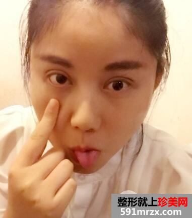 四川娇点整形价格表 切开双眼皮整形案例分享