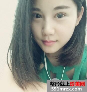 四川娇点整形价格表 切开双眼皮整形案例分享