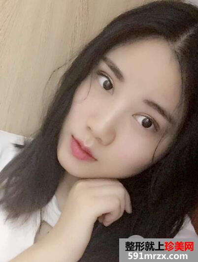 四川娇点整形价格表 切开双眼皮整形案例分享