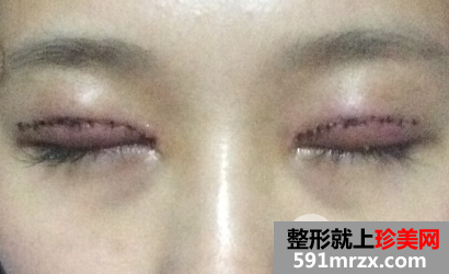 北京京民医院价格表 郭建玲切开双眼皮修复案例