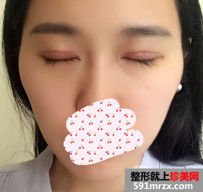 北京京民医院价格表 郭建玲切开双眼皮修复案例