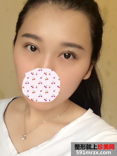 北京京民医院价格表 郭建玲切开双眼皮修复案例