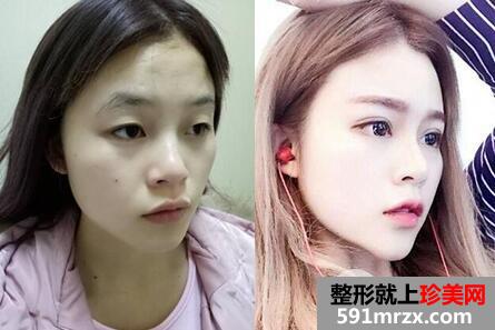 上海华美医疗美容医院靠谱吗？双眼皮微整形价格表