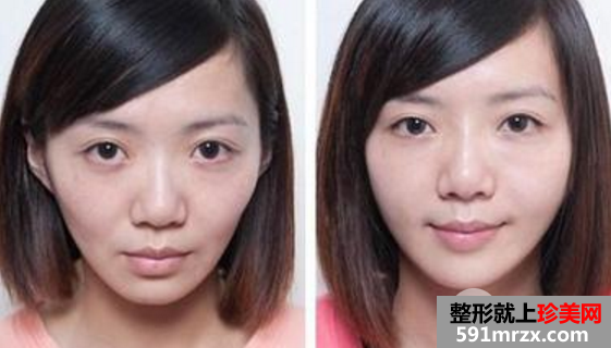 玻尿酸和自体脂肪填充面部凹陷哪个好?优劣势全面对比分析
