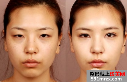 玻尿酸和自体脂肪填充面部凹陷哪个好?优劣势全面对比分析
