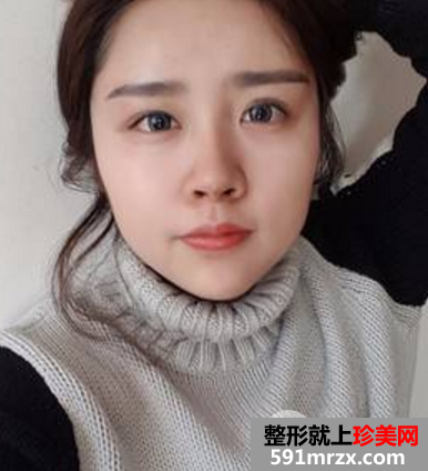 我都快变成整形达人了这次去做了自体脂肪填充太阳穴和额头