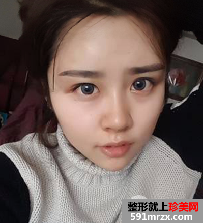 我都快变成整形达人了这次去做了自体脂肪填充太阳穴和额头