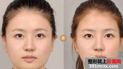 去颊脂垫价格一般多少钱?瘦脸效果明显吗?