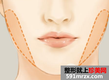 去颊脂垫价格一般多少钱?瘦脸效果明显吗?