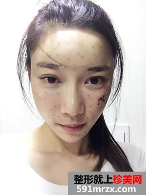 自体脂肪填充全脸prp真实案例分享和恢复过程照片对比