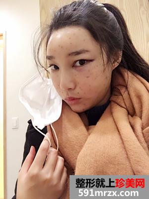 自体脂肪填充全脸prp真实案例分享和恢复过程照片对比