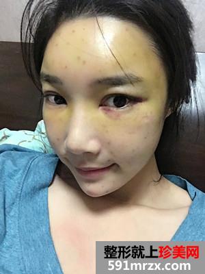 自体脂肪填充全脸prp真实案例分享和恢复过程照片对比