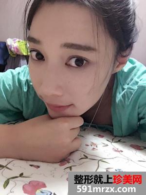 自体脂肪填充全脸prp真实案例分享和恢复过程照片对比