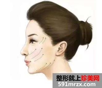 什么是线雕?都有什么效果吗?