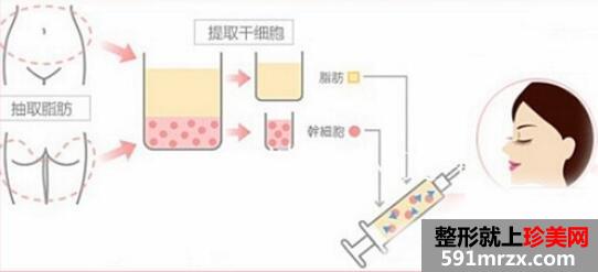 自体脂肪填充泪沟后需要注意些什么