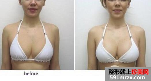 自体脂肪隆胸有年龄上的限制吗？