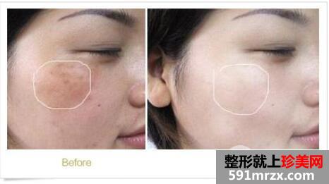 疤痕斑点怎么办