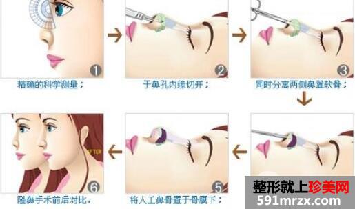 隆鼻材料哪个好？自体软骨隆鼻最适合