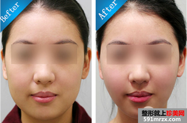 吸脂瘦脸有效吗？效果怎么样？术后应该怎样护理？