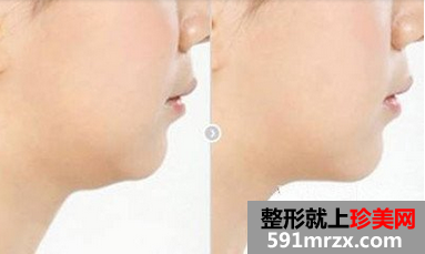 快速去除双下巴的方法有哪些？超声吸脂瘦双下巴怎么样？