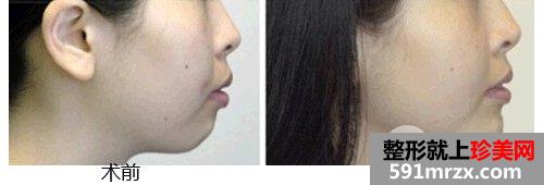 做去双下巴手术有风险和后遗症吗？