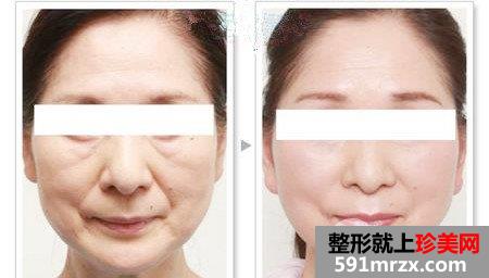 激光去除皱纹有哪些优势及特点？